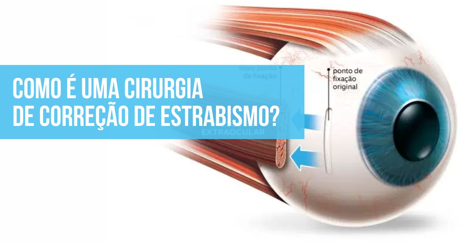 Plano De Saúde Cobre Cirurgia De Estrabismo? Veja Em Qual Caso é Coberto